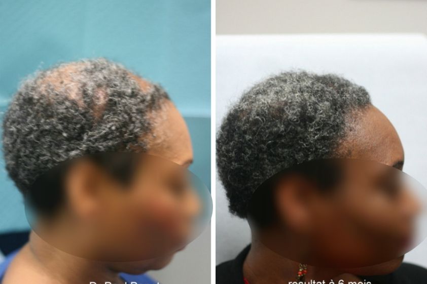 Greffe de cheveux avant et après - 633878