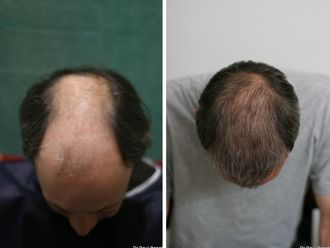 Greffe de cheveux avant et après - 633897