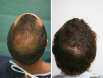 Greffe de cheveux - 633900