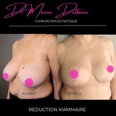 Réduction mammaire