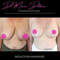 Réduction mammaire