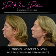 Fils tenseurs permanents