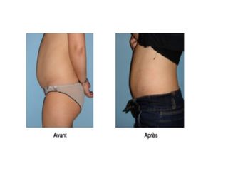 Avant après Liposuccion