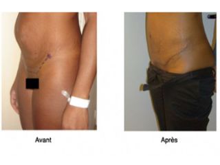 Avant après Abdominoplastie