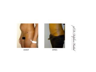 Avant après Abdominoplastie