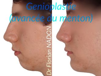 Génioplastie - 569732
