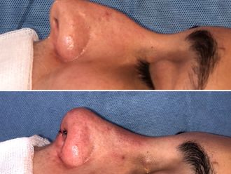 Rhinoplastie - 787324