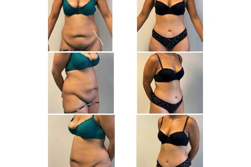 Abdominoplastie avant et après - 821984