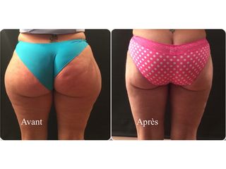 Avant après Liposuccion de la culotte de cheval