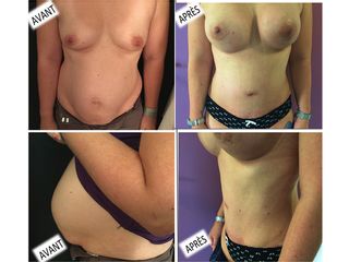 Avant après Abdominoplastie et augmentation mammaire