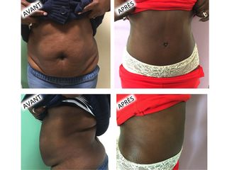 Avant après abdominoplastie