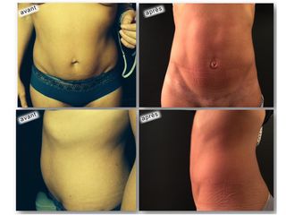 Avant après Mini plastie abdominale = Mini cicatrice = Maxi travail chirurgical