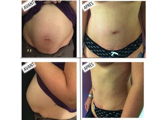 Avant après Abdominoplastie après grossesse