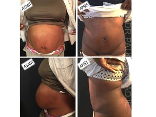 Avant après Abdominoplastie après grossesse