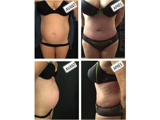 Avant après Abdominoplastie