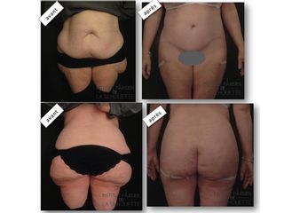 Avant après Liposuccion et abdominoplastie