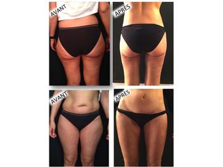 Avant après Liposuccion