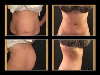 Avant après Plastie abdominale après grossesse