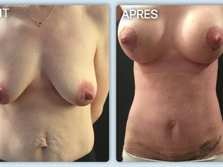 Avant après Plastie abdominale + Plastie mammaire