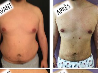 Avant après Liposuccion homme