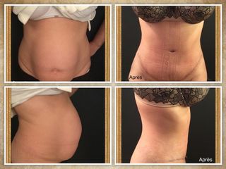 Avant après Plastie abdominale après grossesse