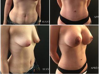 Avant après Combiné seins ventre
