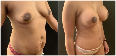 Liposuccion - Dr Paul Seknadje