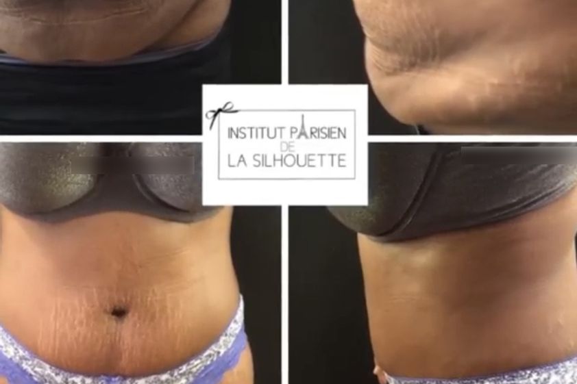 Abdominoplastie avant et après - 863081