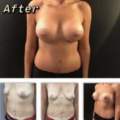Augmentation mammaire - Dr Paul Seknadje