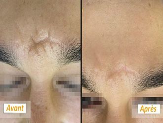 Traitement cicatrice Avant et après - Multiesthetique.fr