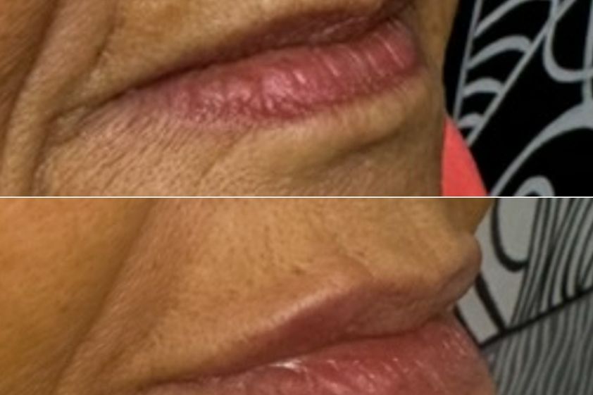 Augmentation des lèvres avant et après - 871472