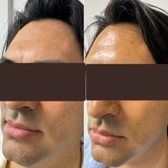 Définition des contours par SKINBOOSTER Biostimulateur - Centre Mesos