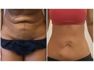 abdominoplastie - Dr Laurent Benadiba