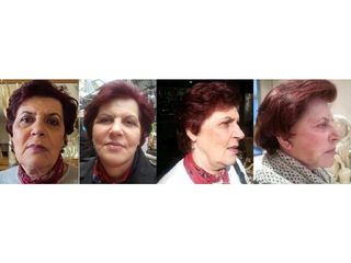 Peeling - Dr Laurent Benadiba