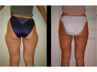 Liposuccion - Dr Laurent Benadiba