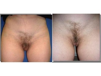 Nymphoplastie avant et après - 818851