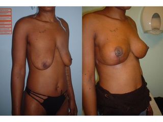 Mastopexie - Dr Laurent Benadiba