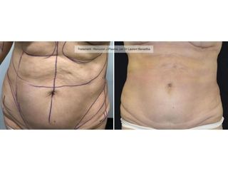 Liposuccion - Dr Laurent Benadiba