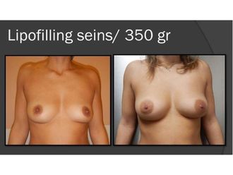 Lipofilling avant et après - 818857