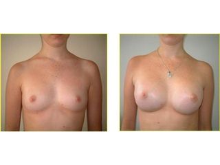Augmentation mammaire - Dr Laurent Benadiba