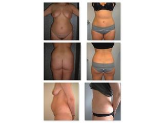 Liposuccion - Dr Laurent Benadiba