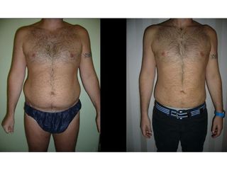 Liposuccion - Dr Laurent Benadiba