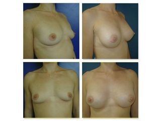 Augmentation mammarie - Dr Laurent Benadiba