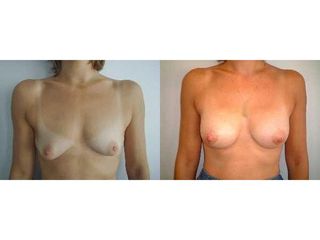 Augmentation mammaire - Dr Laurent Benadiba