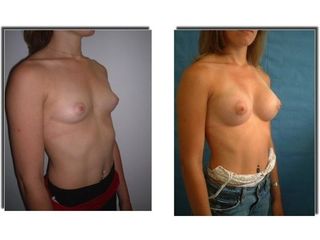 Augmentation mammaire - Dr Laurent Benadiba