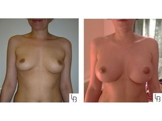 Augmentation mammaire - Dr Laurent Benadiba