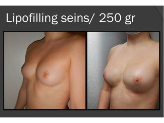 Lipofilling avant et après - 818879