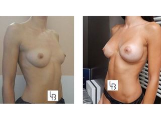 Augmentation mammaire - Dr Laurent Benadiba