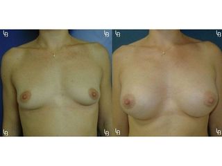 Augmentation mammaire - Dr Laurent Benadiba