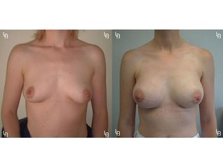 Augmentation mammaire - Dr Laurent Benadiba